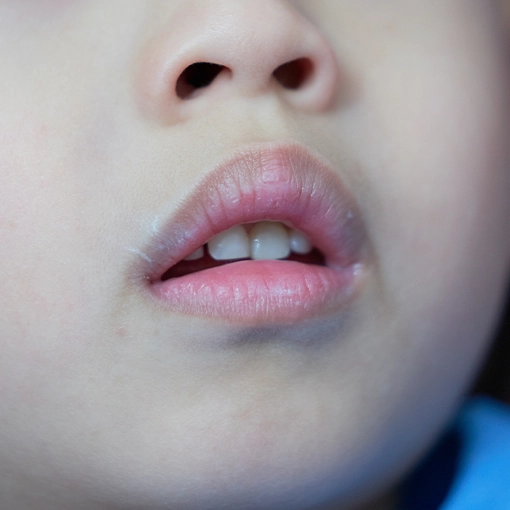 Infection dentaire chez un enfant Annecy